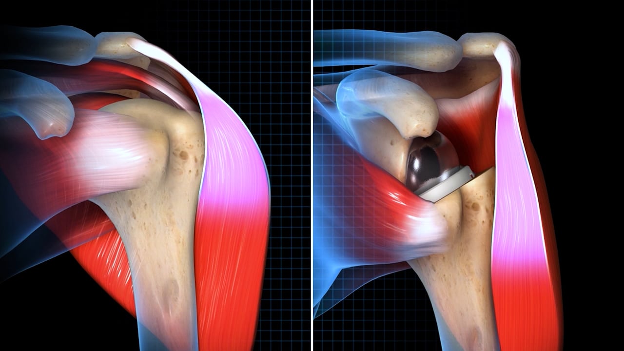 Biomechanical Summary of Equinoxe Reverse Shoulder Arthroplasty